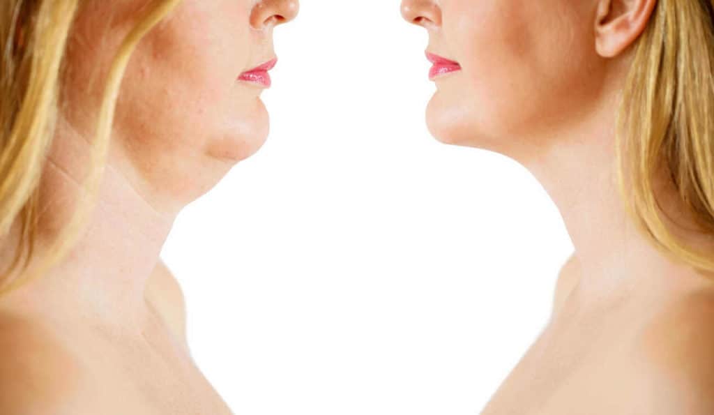 Double Chin treatment Hale End before and after results