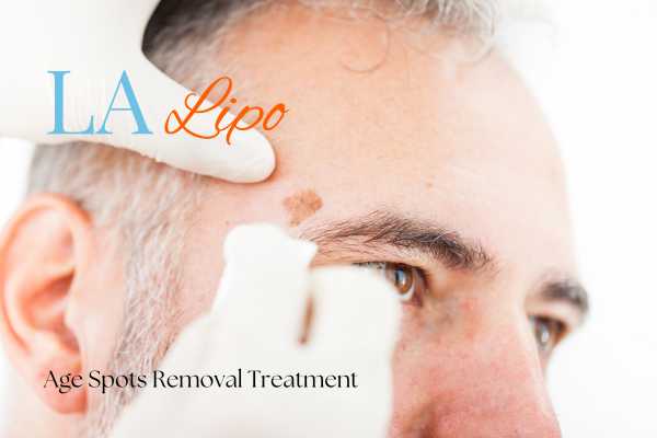 What Are the Most Effective Treatments for Age Spots Hale End?