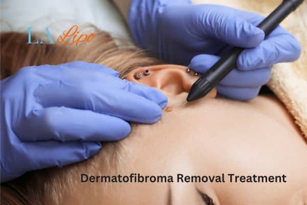 Dermatofibroma Removal Treatment Hale End