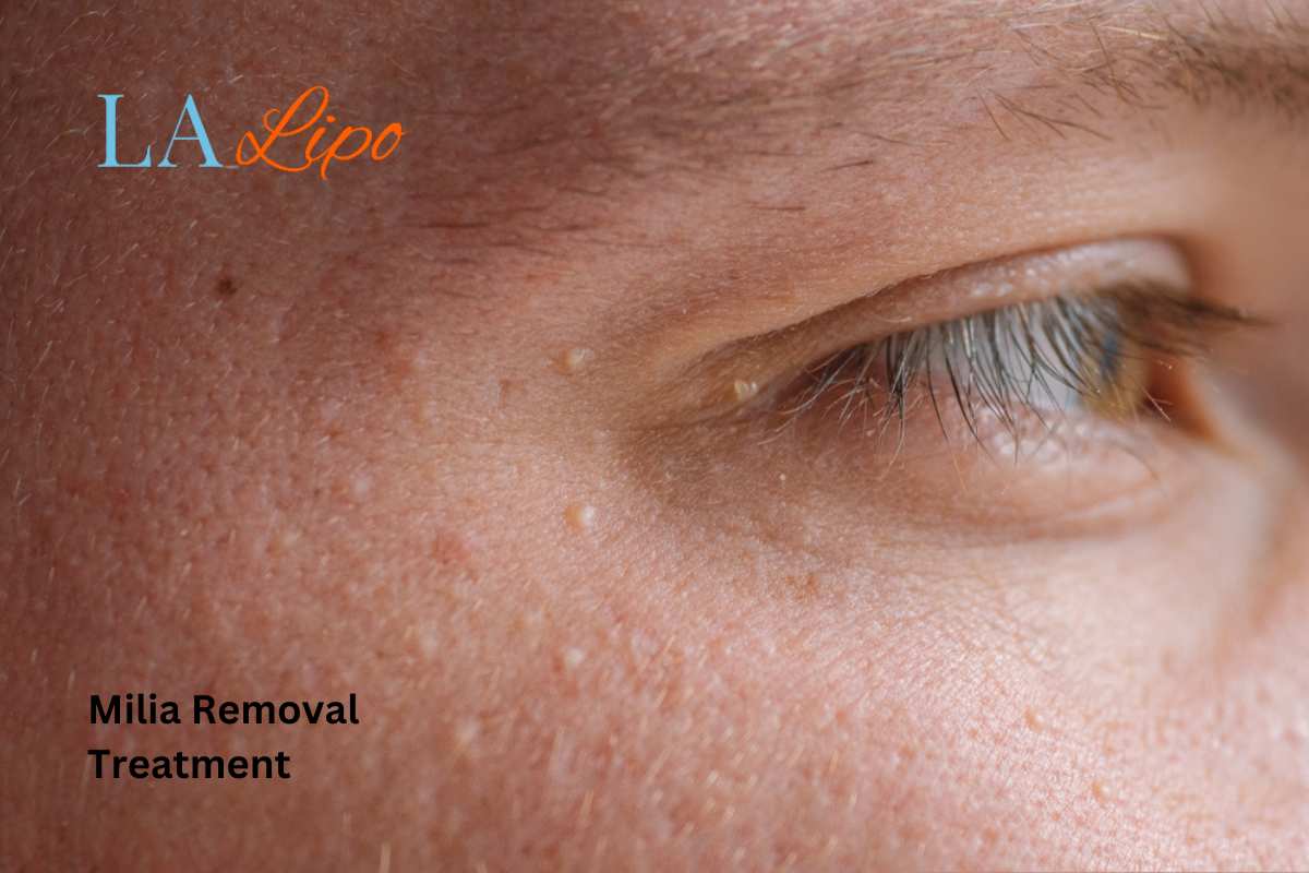 Cryopen Milia Removal: Is It the Easiest and Safest Option Hale End?