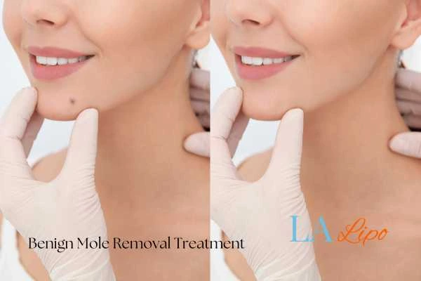 woman's before and after mole removal Hale End results