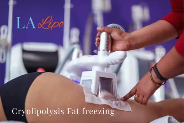 women getting fat freezing Hale End