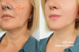 hi-fu for wrinkles Hale End before and after results