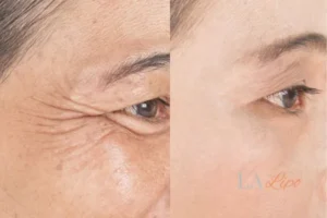 Before and after results of woman - HI-fu wrinkles reduction treatment Hale End