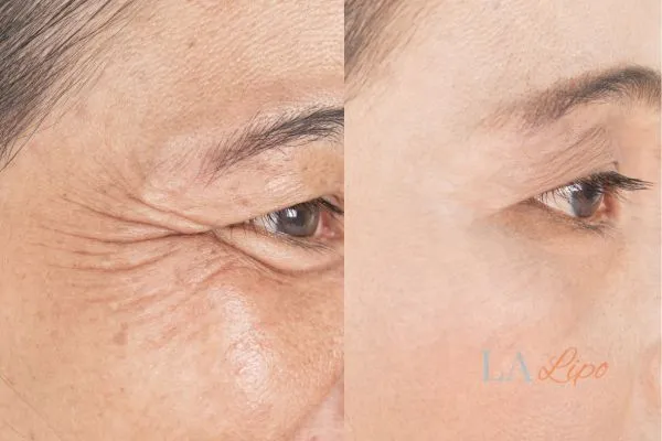 Before and after results of woman - HI-fu wrinkles reduction treatment Hale End