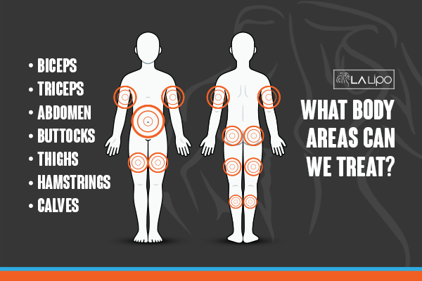 Graphic to show areas you can have LA-EMS Body Sculpting Hale End treatment.
