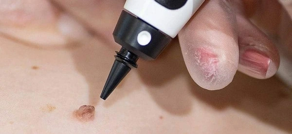 skin tag removal using cryopen Hale End