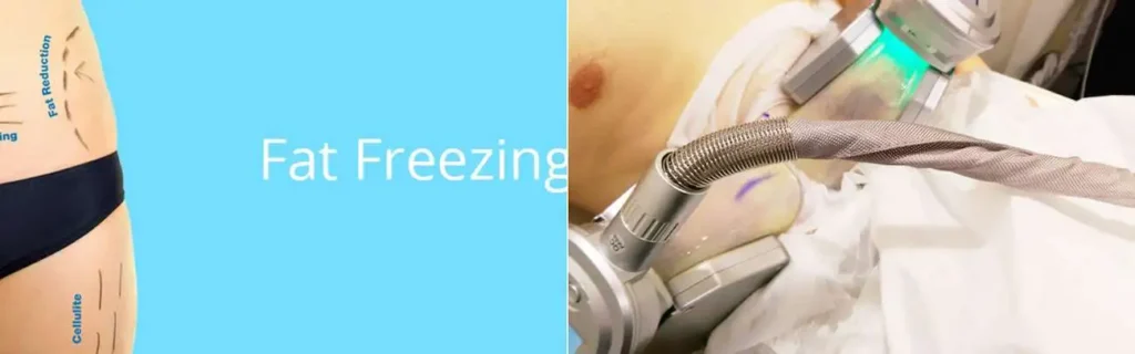 Fat freezing Hale End on multiple areas of the body