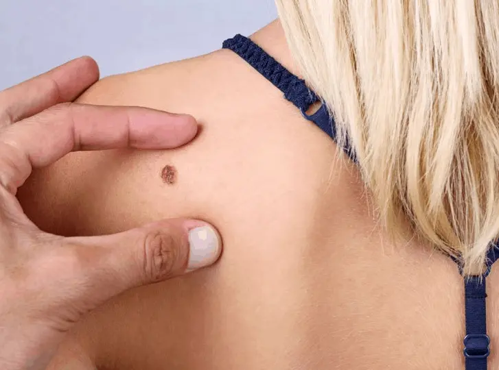 woman having mole removal Hale End consultation before treatment.