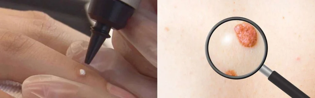CryoPen practitioner Hale End assessing a benign mole before treatment