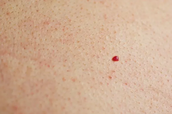 close up of a cherry angioma Hale End