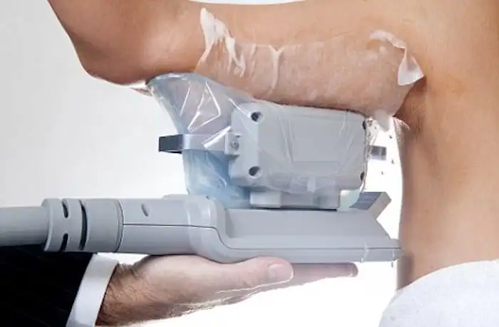 Picture of fat freezing Hale End on the upper arms.