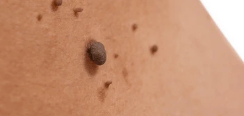image of a skin tag Hale End