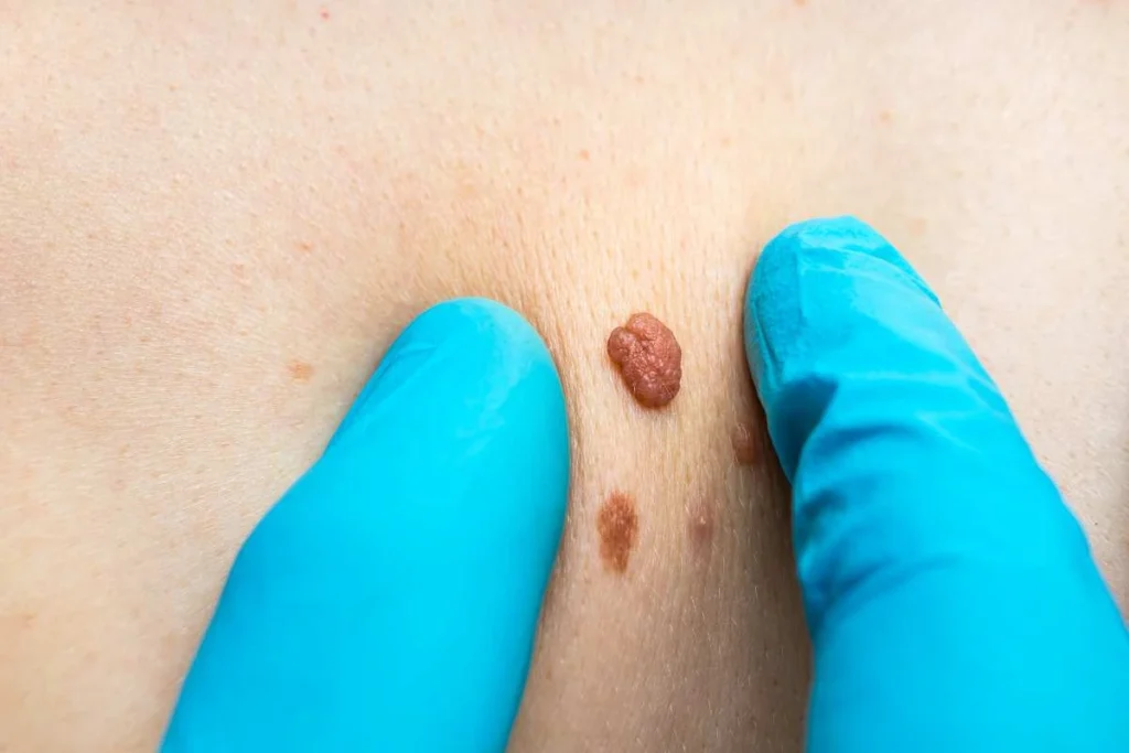 Consultant examining a skin tag Hale End