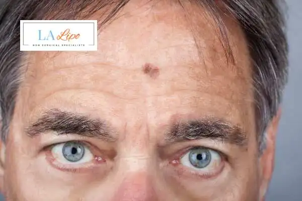 Solar Lentigo Removal Hale End image of man with mark on his forehead