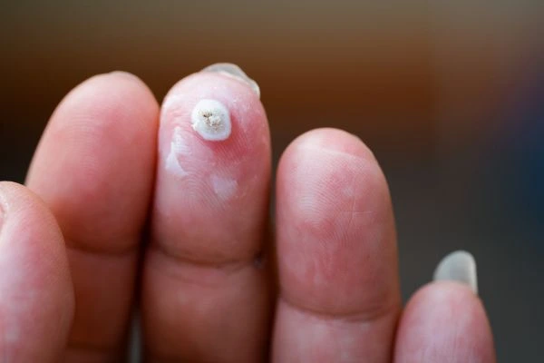 wart on person finger - cryotherapy to treat from LA LIPO Hale End