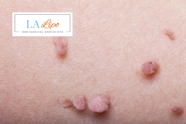 Does cryopen skin tag removal Hale End hurt? Find out now call our team today!