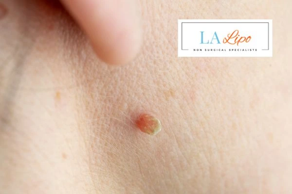 Book skin tag removal Hale End today speak to our team now!