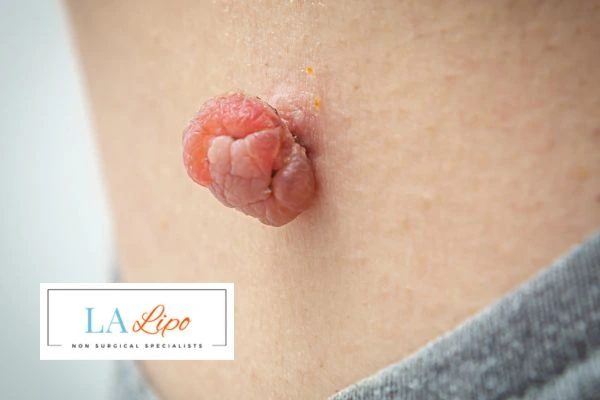 Interested in skin tag removal Hale End? Concerned about the pain? Find out more today!