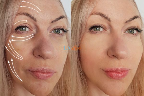 Morpheus 8 results Hale End face lift.