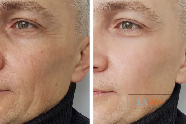 See the amazing results of Morpheus8 Treatment Hale End!