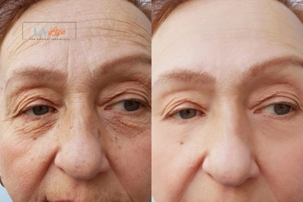 The powerful benefits of Morpheus8 Treatment Hale End - Call Our team today!