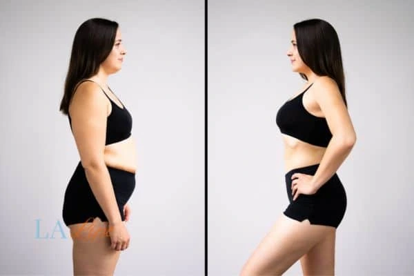 Picture of womans before and after using LA-EMS body sculpting to improve her core strength Hale End