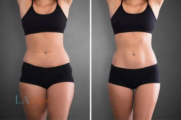 before and after results of non-surgical treatment to help a woman's body image and mental health Hale End