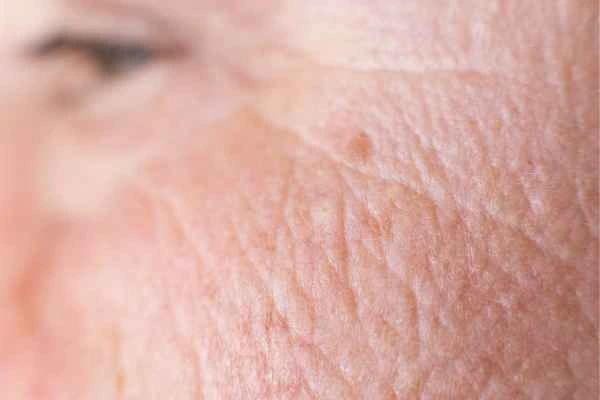 close up picture of a woman's face showing an age spot Hale End