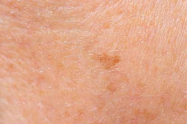 close up picture of age spots Hale End
