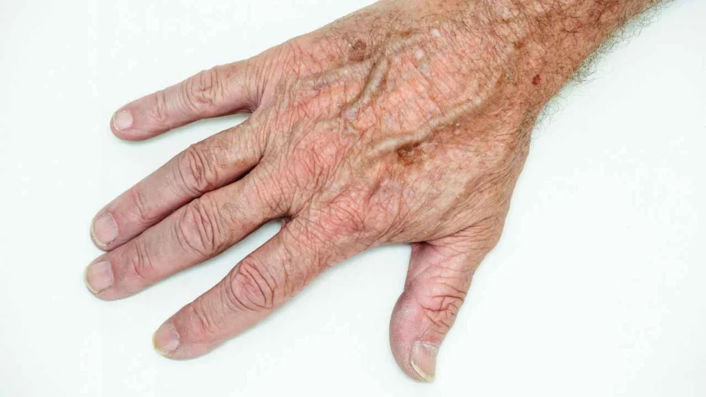 Male hand showing age spot Hale End