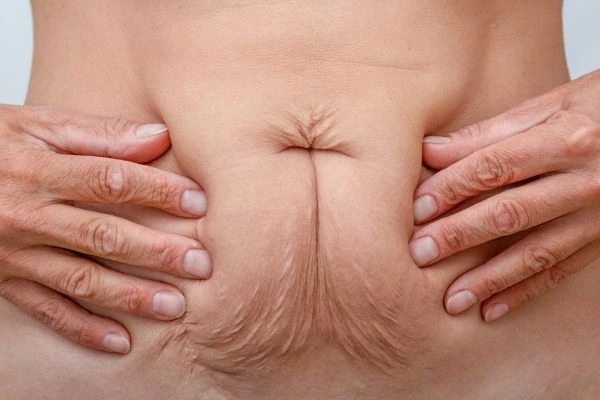 Should I Combine Diastasis Recti Treatment with Body Contouring for Better Results Hale End?
