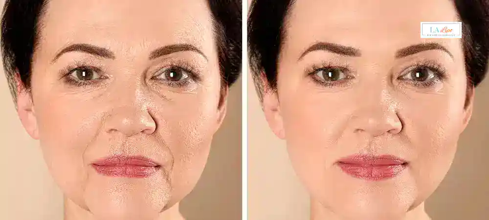 How Long Does It Take to See Results and How Long Do They Last Hale End?