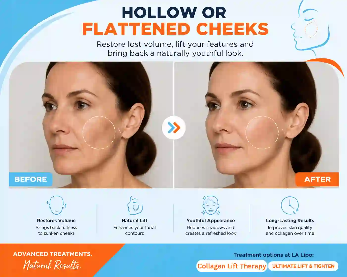 Sign #4: Hollow or Flattened Cheeks Hale End
