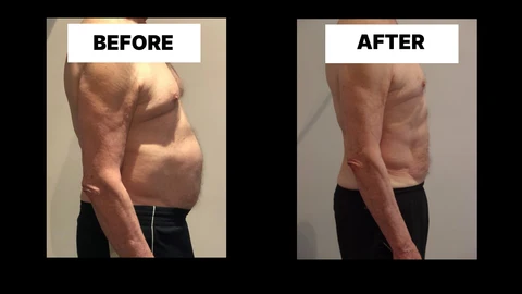 What Symptoms Can Diastasis Recti Cause in Men? Weak Core, Back Pain and Poor Posture Hale End